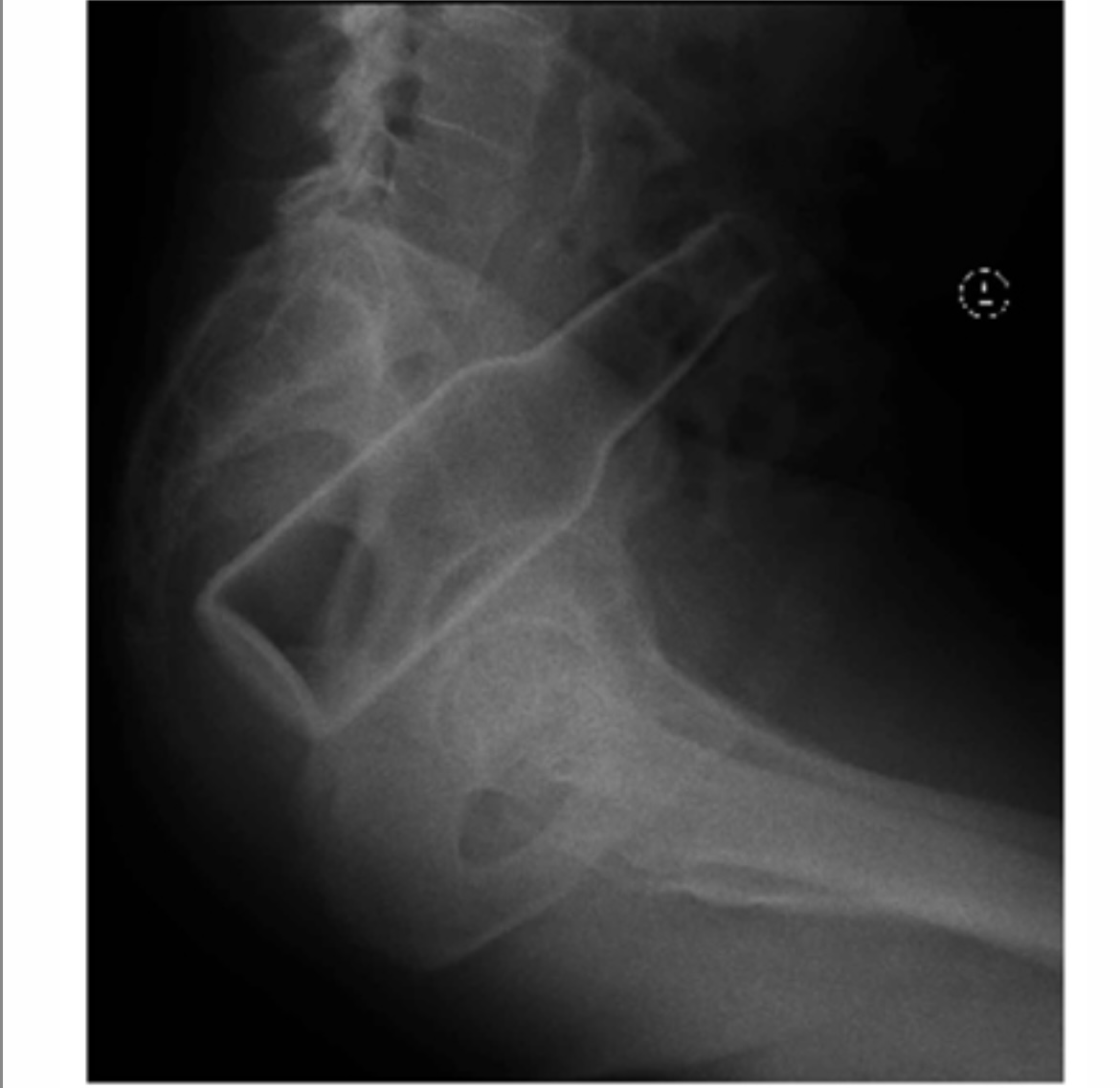 What is Polyembolokoilamania?