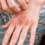 What is Fictitious Dermatitis?