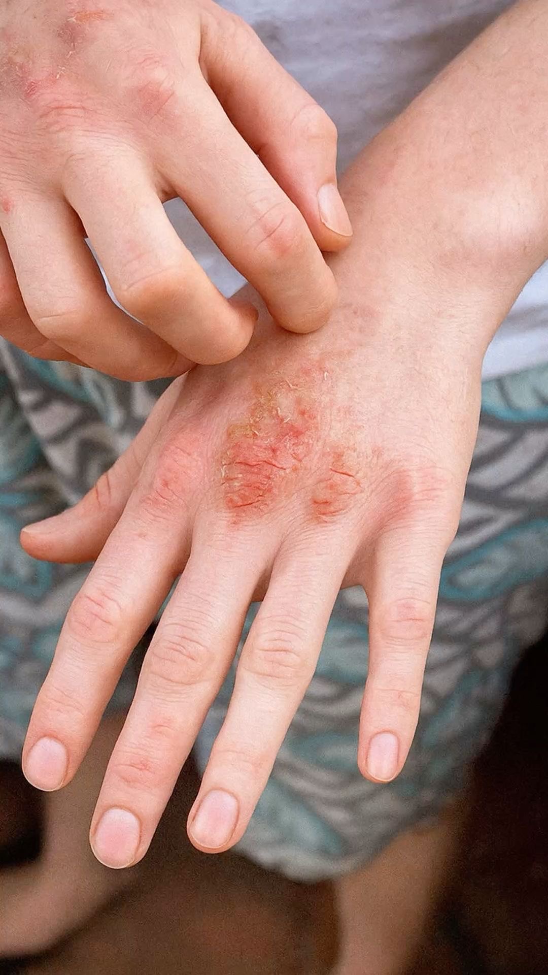 What is Fictitious Dermatitis?